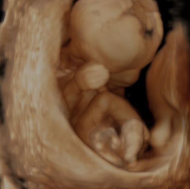 3D beeld van een zwangerschap van ca. 16 weken